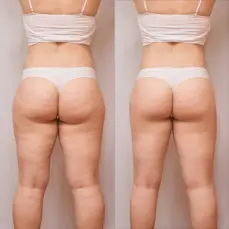 antes después masaje anticelulítico domicilio Sotillo mujer glúteos definidos