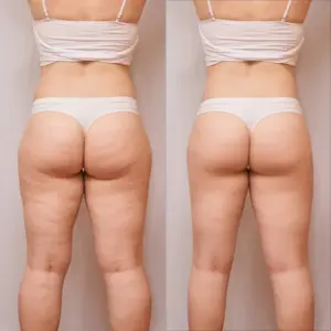 antes después masaje anticelulítico domicilio Sotillo mujer glúteos definidos